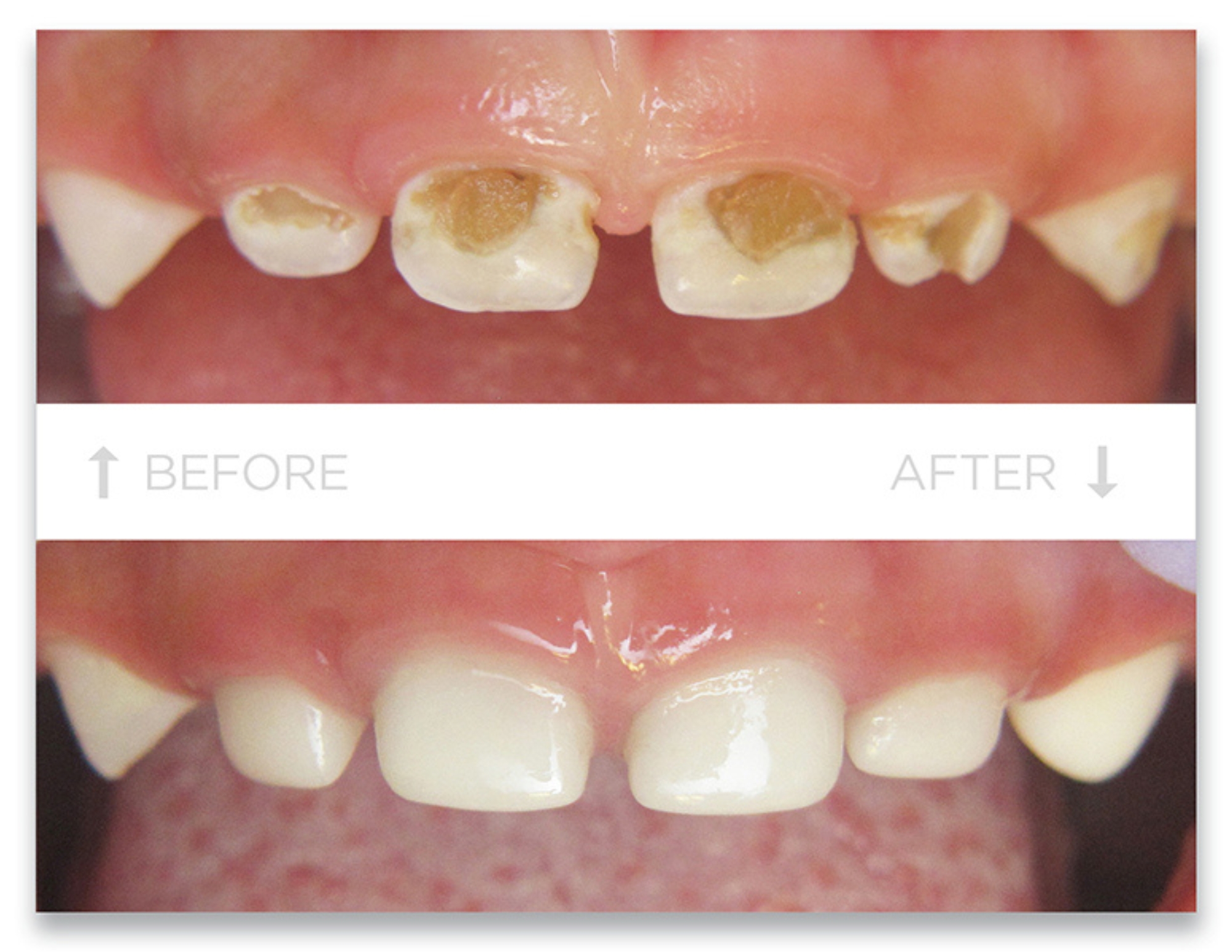 EZCrown-Case-Websit.jpg (1) Pediatric White Crowns