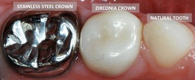 white-vs-silver-crowns Pediatric White Crowns